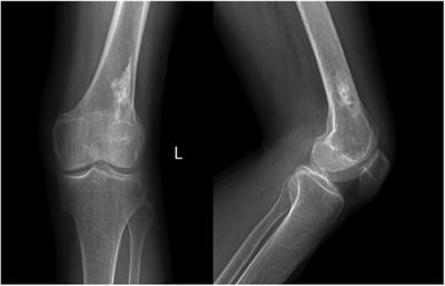 Liposclerosing myxofibrous tumor of the distal femur: A case report